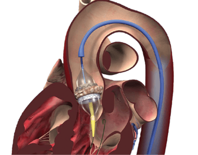 Edwards-SAPIEN-Valve-Gu fmt copy