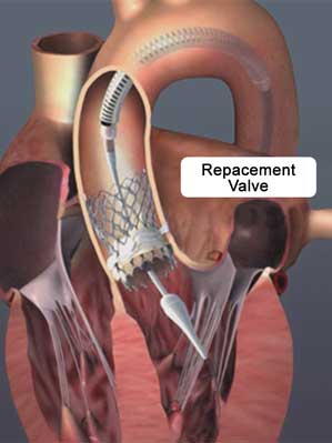 tavr2b