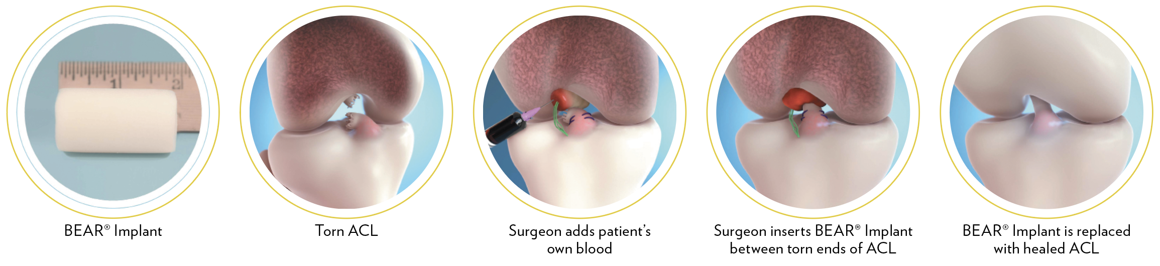 illustration of Bear Implant process